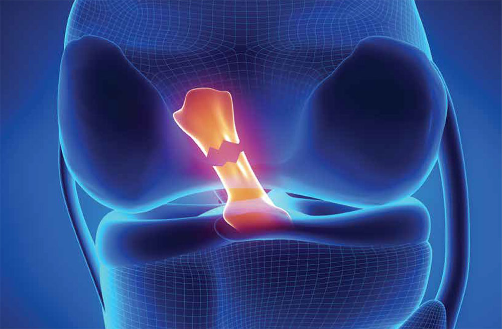 The anterior cruciate ligament threads through the middle of the knee joint. It is the mostcommonly torn ligament in sports.