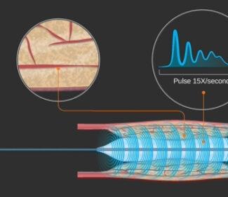Pulse IVL™ uses high-frequency pulsatile pressure waves to fracture arterial calcium.